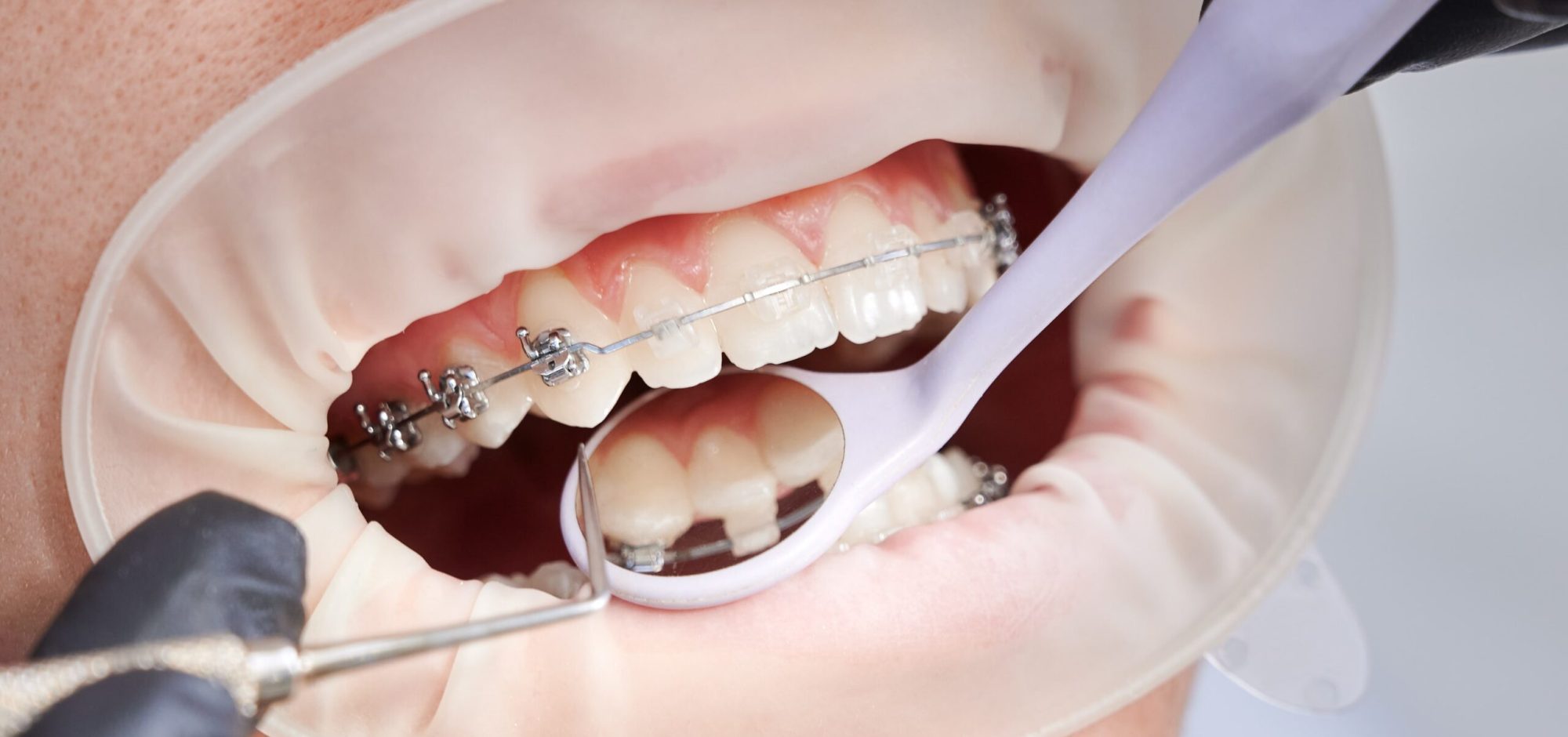 min-ortodonti min-ortodonti